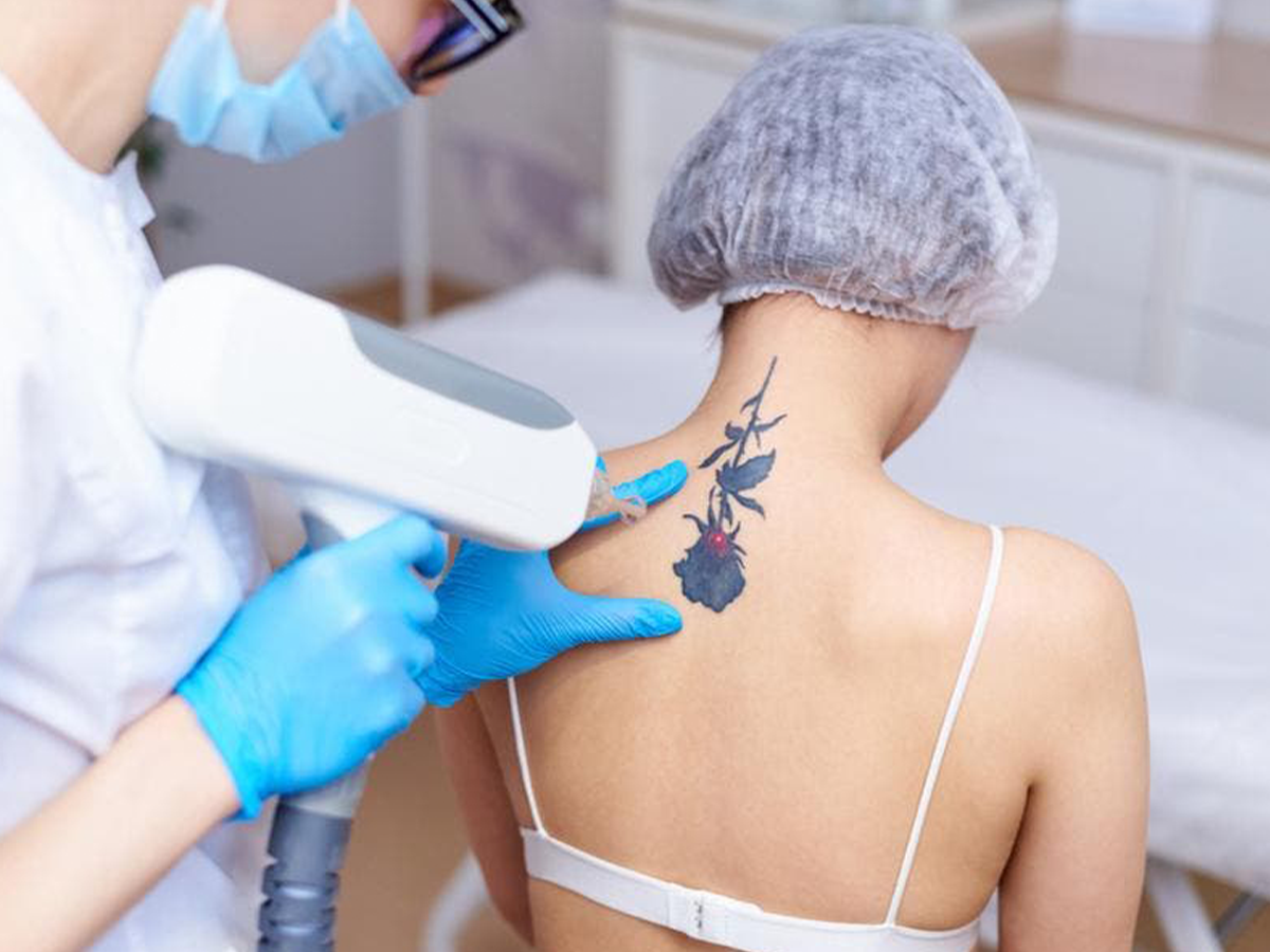 Remoção de Tatuagens e Micropigmentação